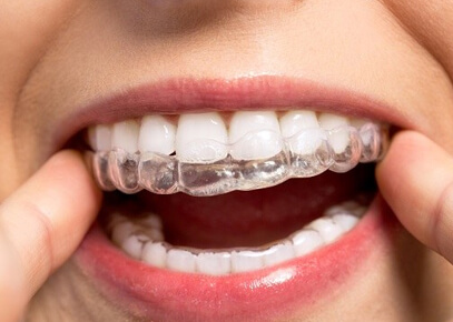 Invisalign & Clear Aligners Melbourne | Carrum Downs Dental Care